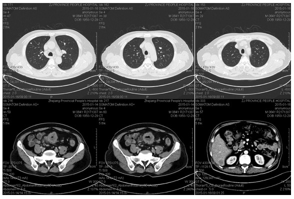 肺部+腹部CT.jpg