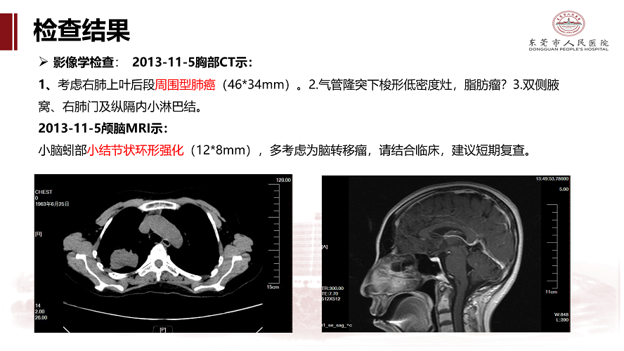 肺癌多学科诊治病例-刘克军_05.png