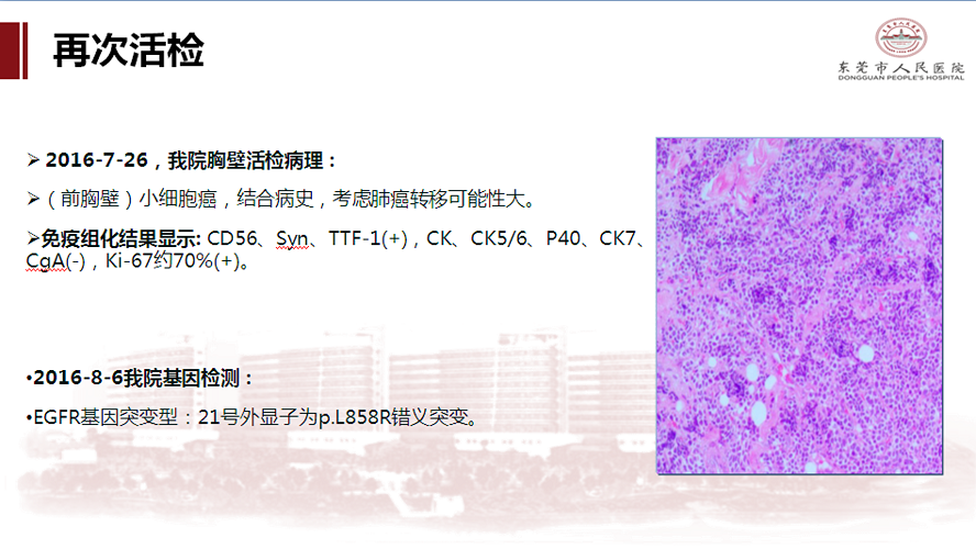 肺癌多学科诊治病例-刘克军_27.png