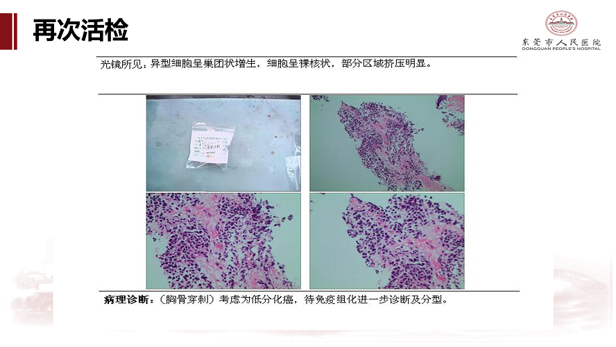 肺癌多学科诊治病例-刘克军_34.png