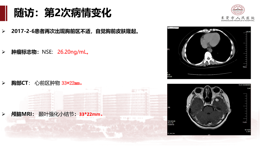 肺癌多学科诊治病例-刘克军_33.png