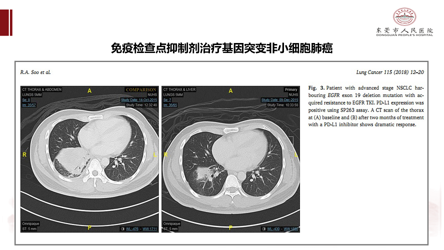 肺癌多学科诊治病例-刘克军_43.png